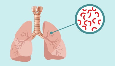 UK Developing New Five-Year Action Plan to Combat Rising TB Cases Image