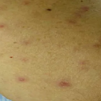 चितवनमा स्क्रब टाइफसबाट एक महिलाको मृत्यु, ७३ जनामा सङ्क्रमण पुष्टि Image