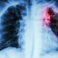 आज विश्व क्षयरोग दिवस मनाइँदै, नेपालमा भेटिए ६७ हजार नयाँ बिरामी Image