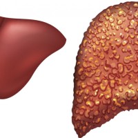 New Study Finds Potential Cure for Fatty Liver Disease Through Enzyme Inhibition Image